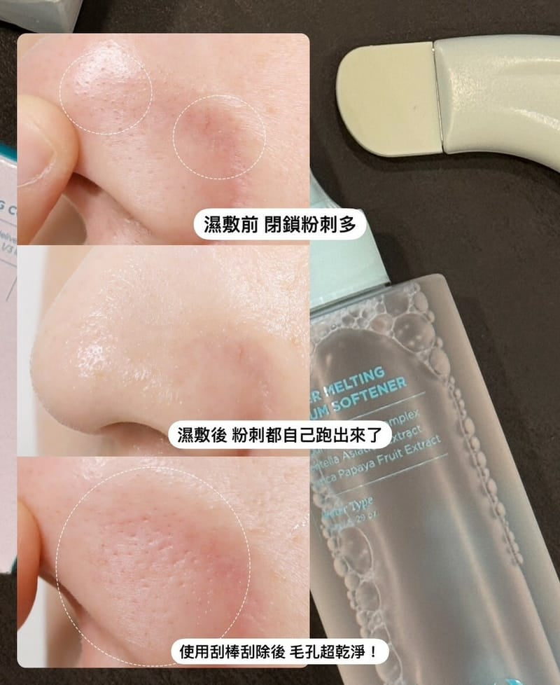\ 去黑頭能力max / ilso💙黑頭粉刺導出液 ☁️