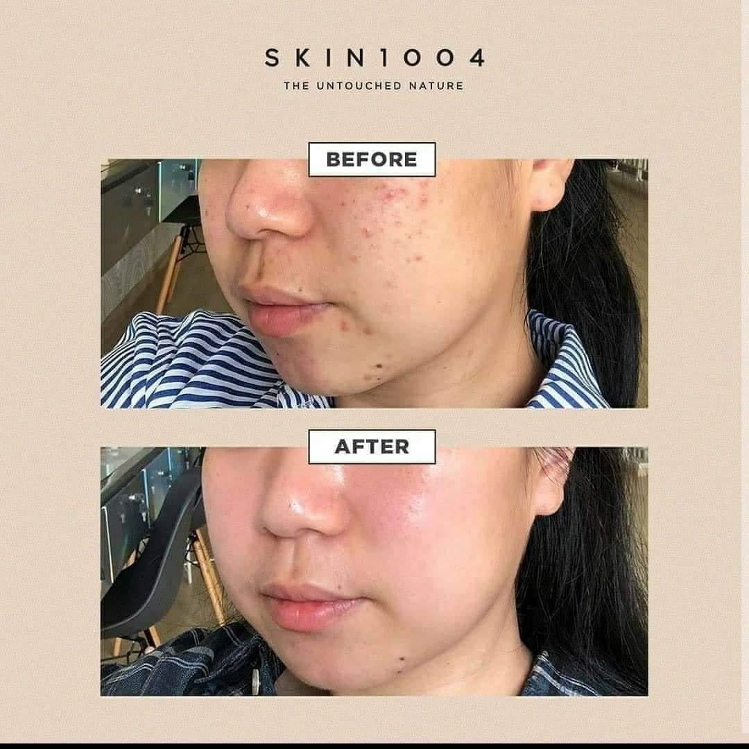 SKIN1004💚馬達加斯加積雪草舒敏精華液 100ml
