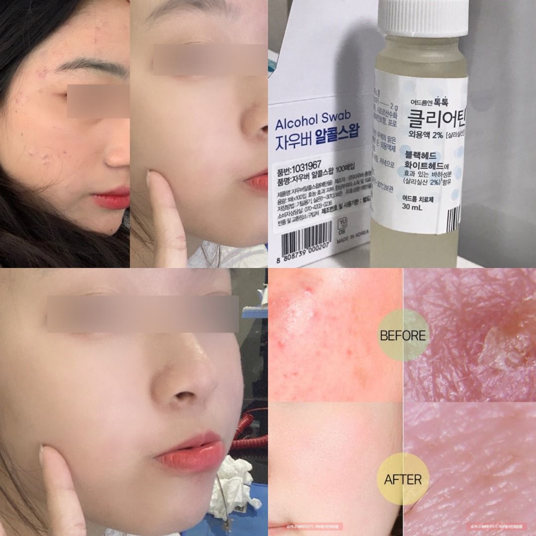 最新版本|HANDOK 💗 Clearteen 韓國國民去暗瘡去痘精華水
