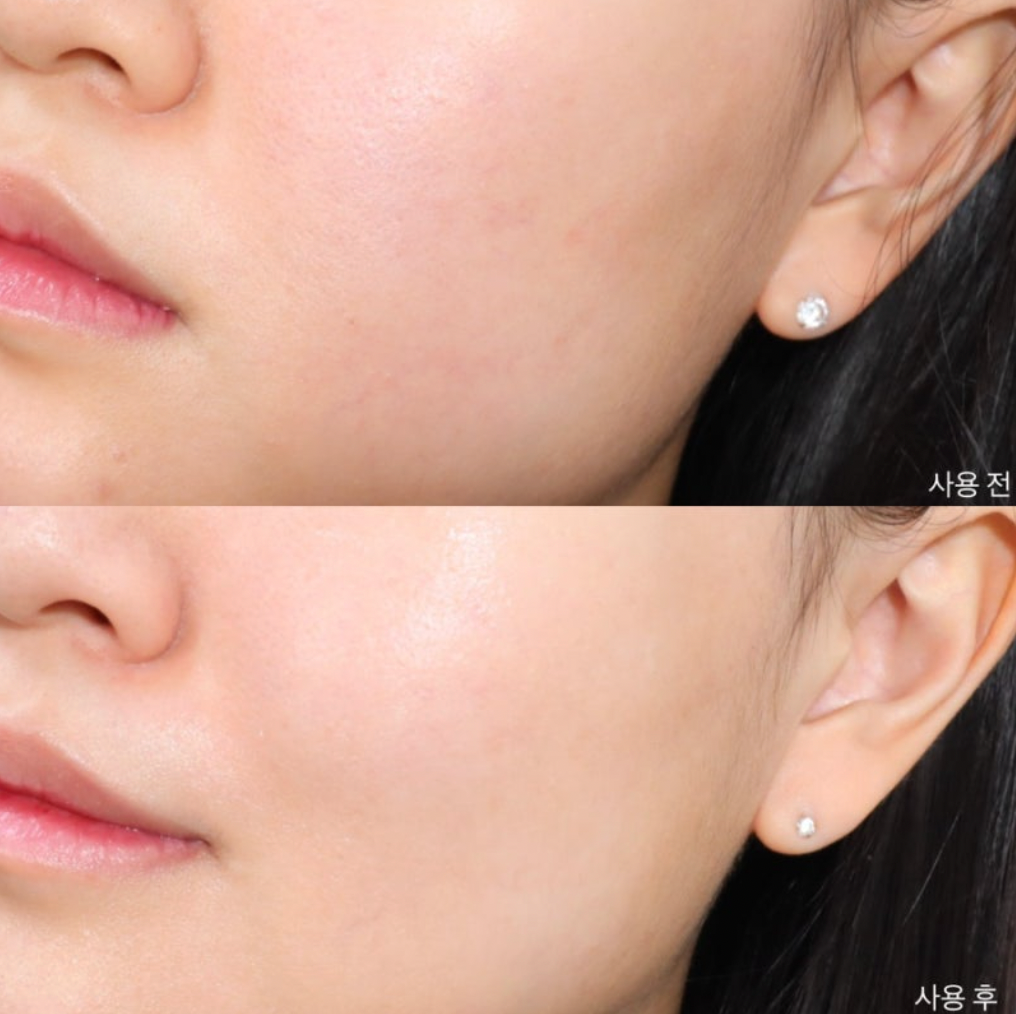 $178🌟1＋1｜MEDICUE ❤️ 抗痘煥顏精華＋棉片套裝