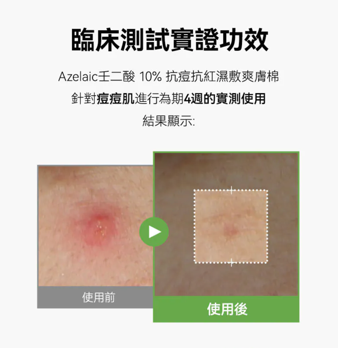 ANUA 🧪 壬二酸10%抗痘抗紅濕敷爽膚棉 ❄️ 90片大容量