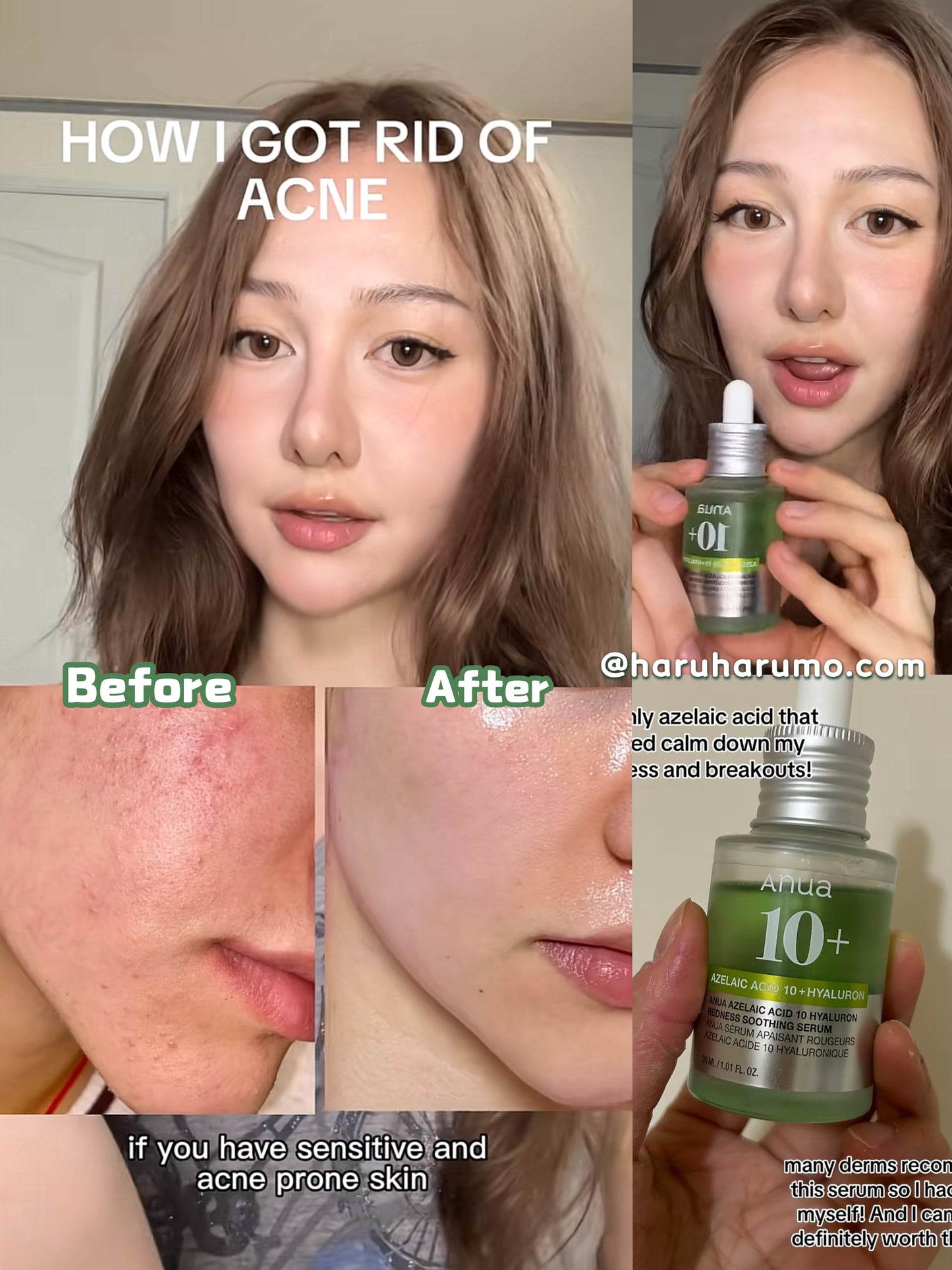 專為敏弱痘肌｜ ANUA 🌿Azelaic壬二酸10%抗痘抗紅修護精華✨