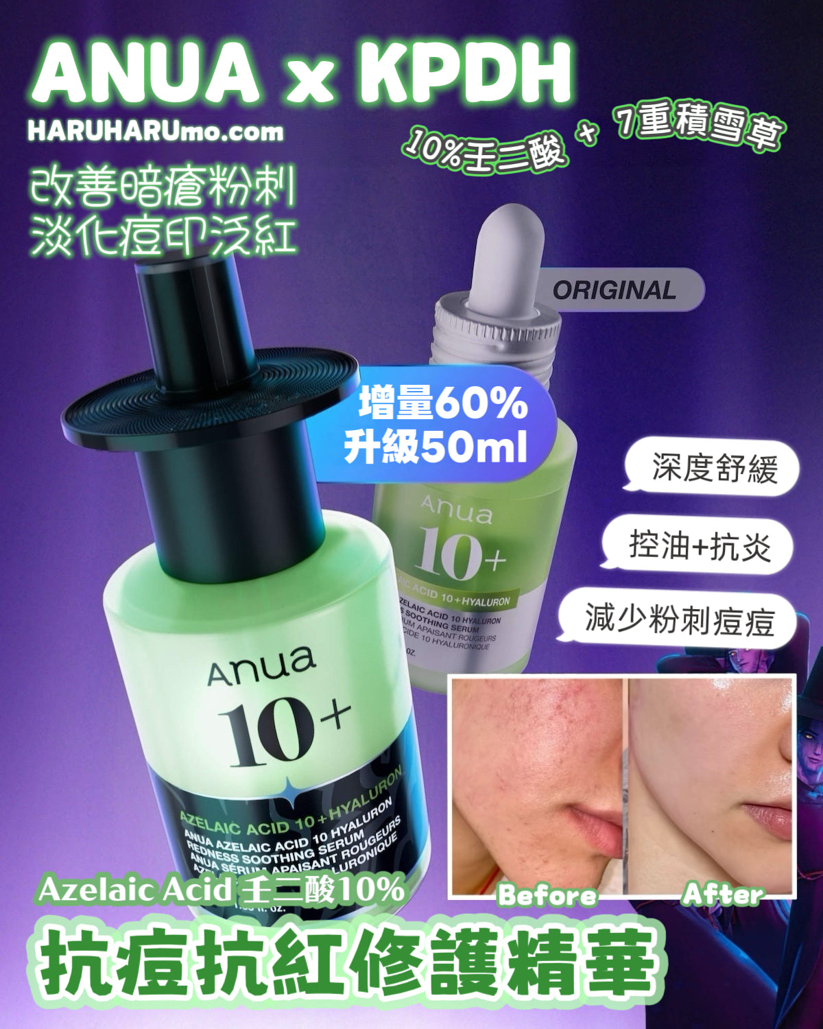 增量60%不加價！快閃優惠兩日✨ ANUA 💚壬二酸10%抗痘抗紅修護精華｜KPDH特別版